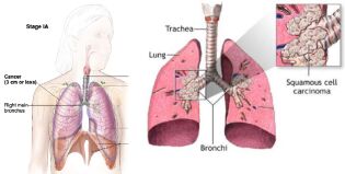 Vest-Agder verst på lungekreft