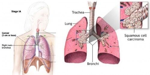 Bildet t.v viser lunger med svulst som antas å være som følge av røyking med filter. Til høyre vises en mer sentral svulst i hovedluftveiene. KILDE: Overlege lungeseksjonen ved SSHF, Dan Lærum.