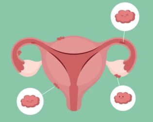 Å leve med endometriose